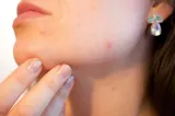 Cum să faci diferența dintre acnee și rozacee?