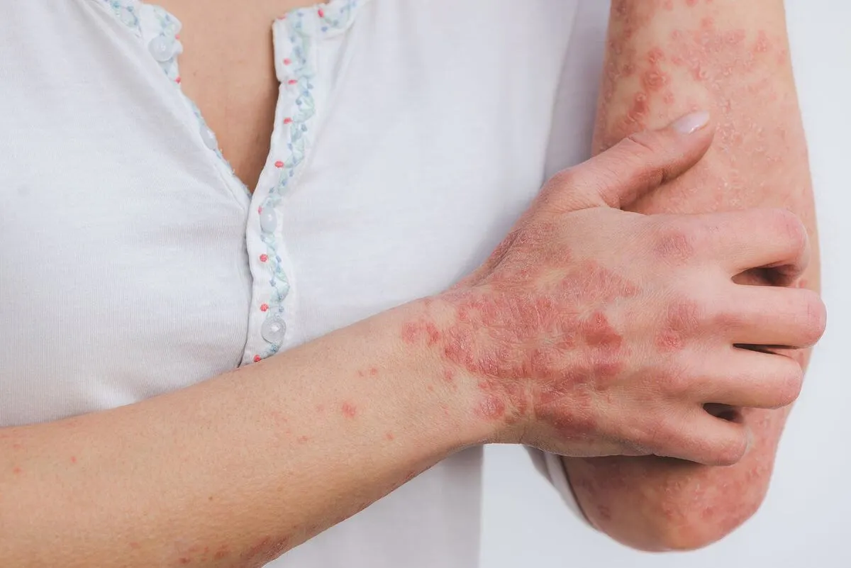 psoriazis
